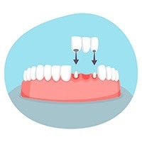 Dental bridge example